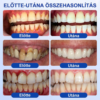 PureShade®👍🦷GumRevive Ínyregeneráló Gél – Az egészségesebb ínyért és magabiztosabb mosolyért 🦷