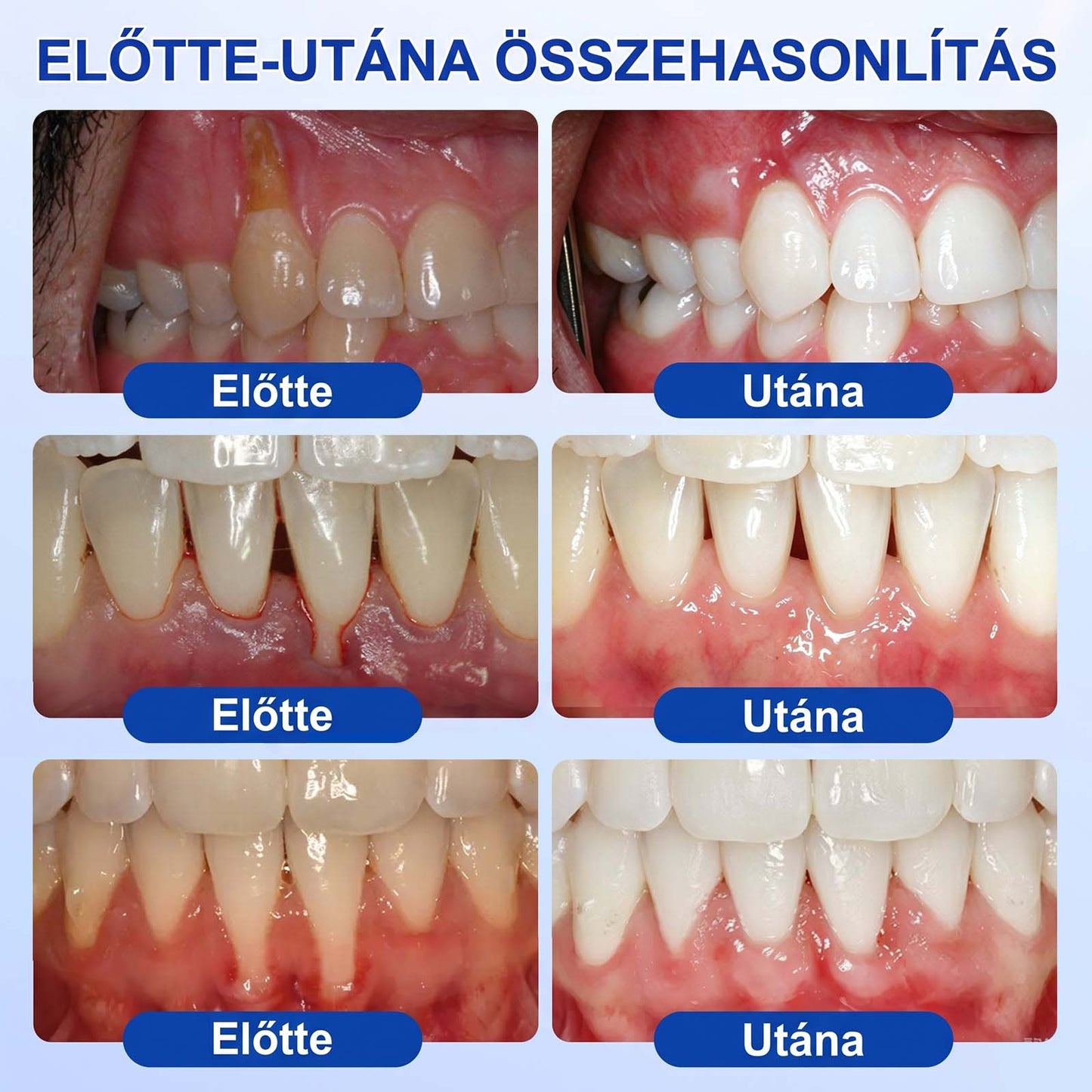 PureShade®👍🦷GumRevive Ínyregeneráló Gél – Az egészségesebb ínyért és magabiztosabb mosolyért 🦷