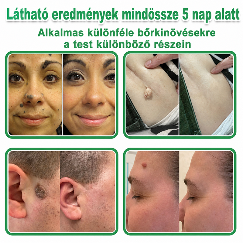 🇭🇺 HAJUEI® 2-az-1-ben Mikrotű & Hidrokoloid Tapasz | Láthatatlan Csillag Tapasz Bőrhibákra, Pattanásokra és Egyenetlen Bőrfelszínre | Arcra és Testre | 144 db ✨