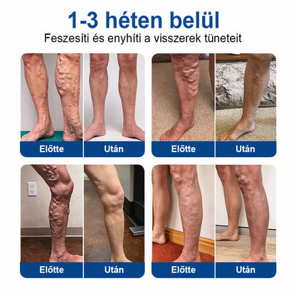 ✨🧑‍⚕️  FFBSI® Visszérápoló Mikrotűs Gondozó Tapasz ⚡ Azonnali Megkönnyebbülés, Hosszú Távú Eredmények
