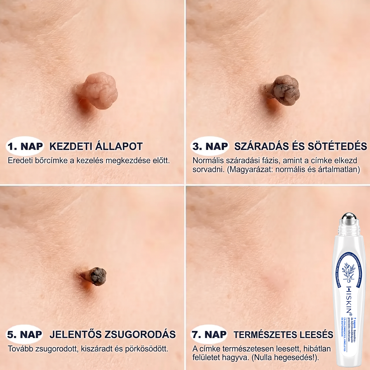 Hiskin®🎁Már csak 5 darab maradt! További 50% kedvezményt biztosítunk!✨ Szerezze be most prémium bőrápolási rutinjához, és ne hagyja ki ezt a különleges ajánlatot.⏰ Ez a kedvezmény csak korlátozott ideig érhető el!
