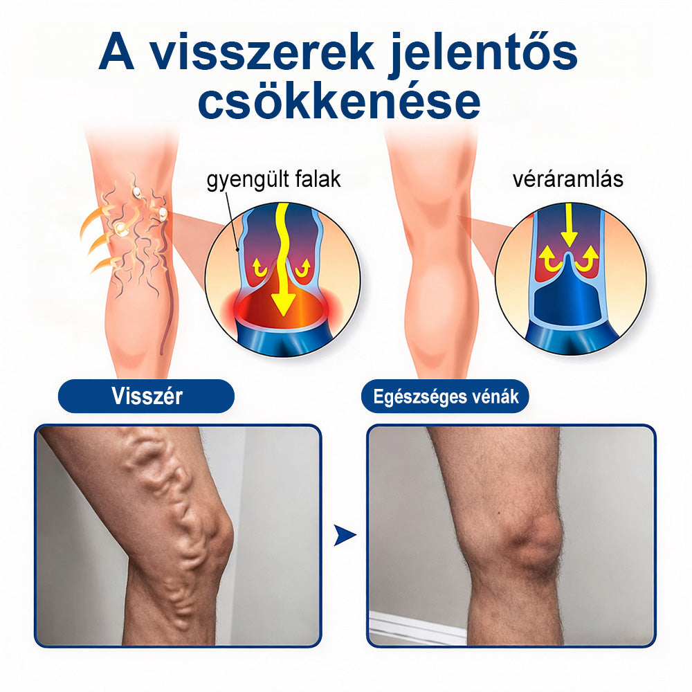 ✨🧑‍⚕️  FFBSI® Visszérápoló Mikrotűs Gondozó Tapasz ⚡ Azonnali Megkönnyebbülés, Hosszú Távú Eredmények