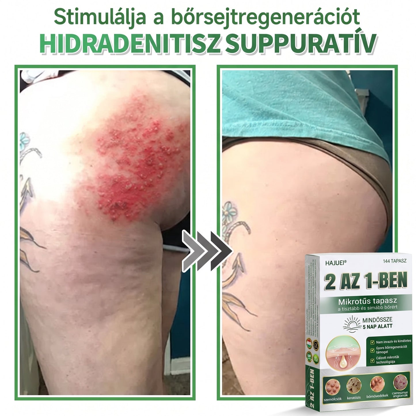 🇭🇺 HAJUEI® 2-az-1-ben Mikrotű & Hidrokoloid Tapasz | Láthatatlan Csillag Tapasz Bőrhibákra, Pattanásokra és Egyenetlen Bőrfelszínre | Arcra és Testre | 144 db ✨