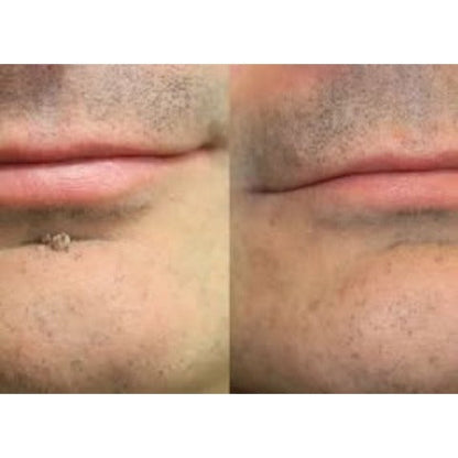 ✨Hiskin ® 2-in-1 Microneedle & Hydrocolloid Patch🍀 | Removes raised moles, acne, flat warts, and skin tags | Helps improve wrinkles, scars, and blemishes | Invisible patches for face and body